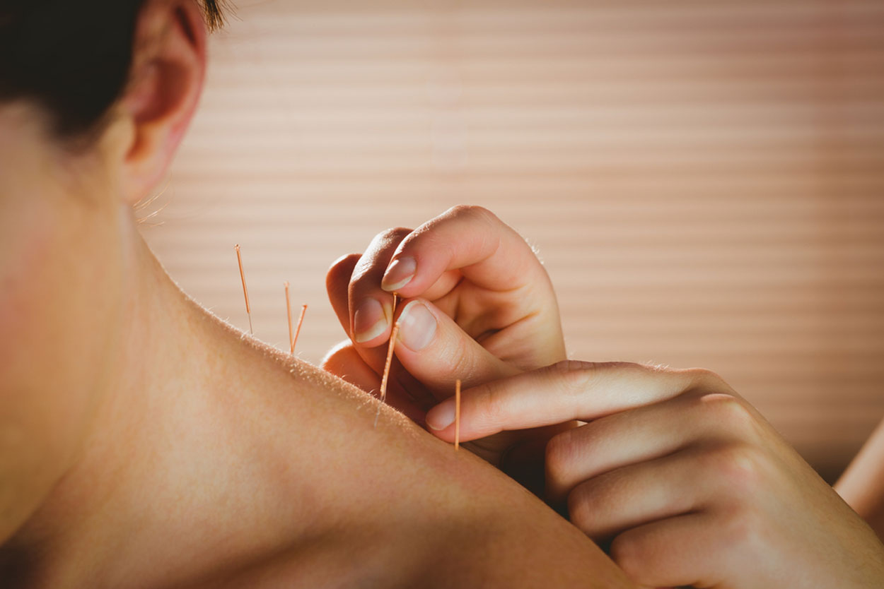 acupuncture for pain